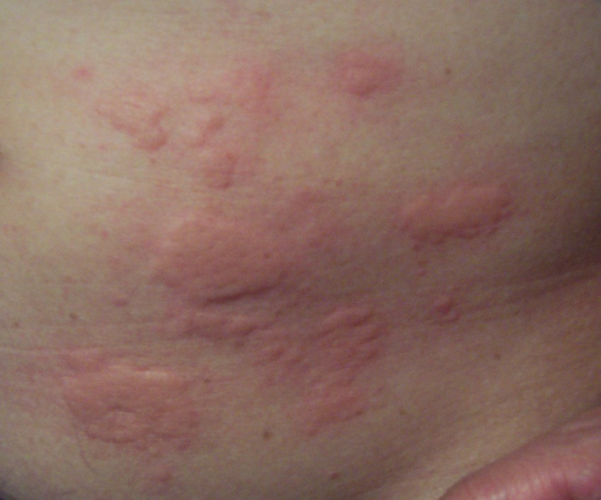 Аллергия в виде ожога на теле