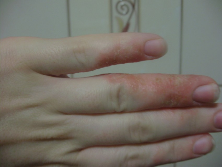 Аллергическая сыпь на теле отек лица thumbnail