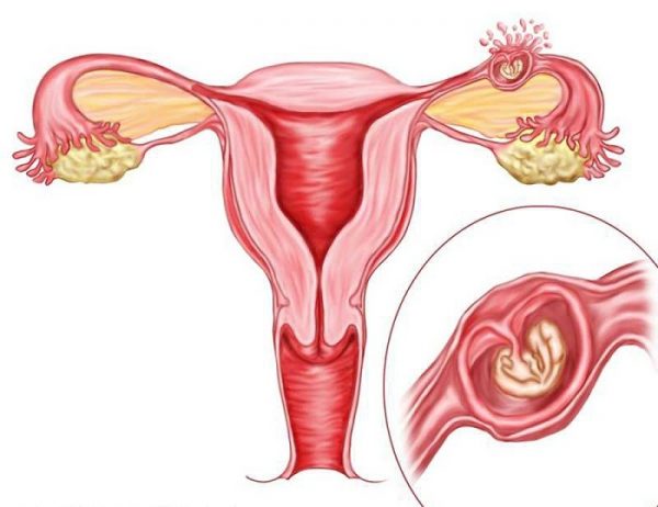 Почему колит левый бок внизу живота у женщины при беременности