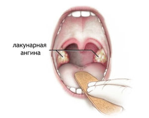 Пневмония и ангина у ребенка thumbnail