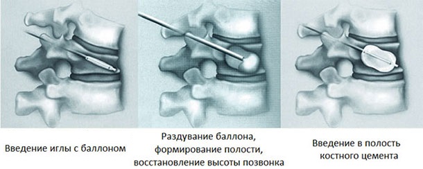 Кифопластика позвонка при компрессионном переломе