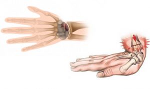 Названия переломов пальцев рук thumbnail