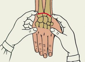 Фиксация руки при переломе лучевой кости thumbnail