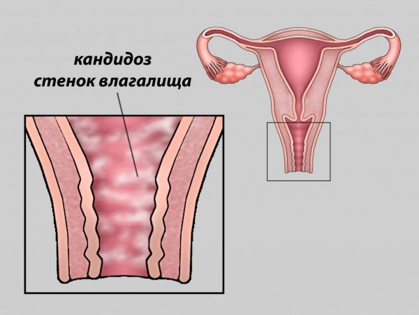 Молочница у женщин на ранних сроках беременности