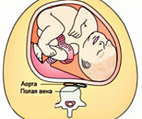 Синдром нижней полой вены у беременной thumbnail