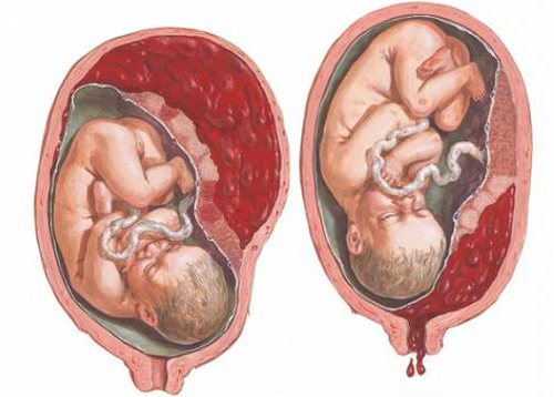 На 5 месяце беременности тянет живот и поясницу