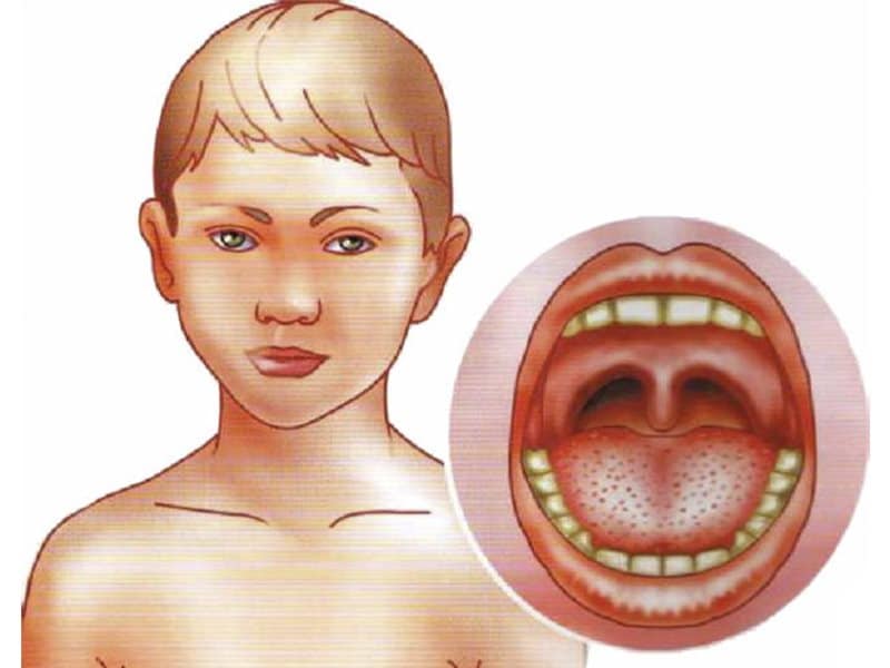 Сыпь температура боль в горле у ребенка